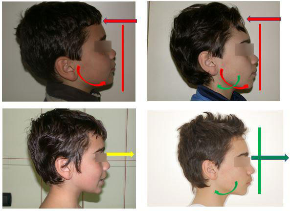 terapia funzionale ortognatodontica.